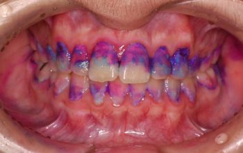 歯肉炎と歯周病の違い