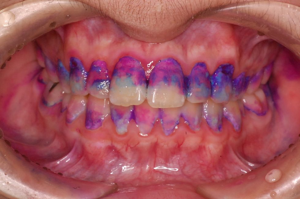 の 腫れ 歯茎 【白い・赤い】歯ぐきが腫れる原因と対策｜歯周病【ブラウンオーラルB】